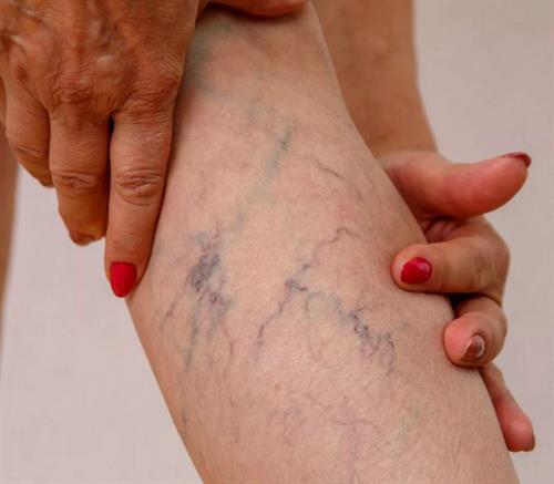 Varicose Vein Patch